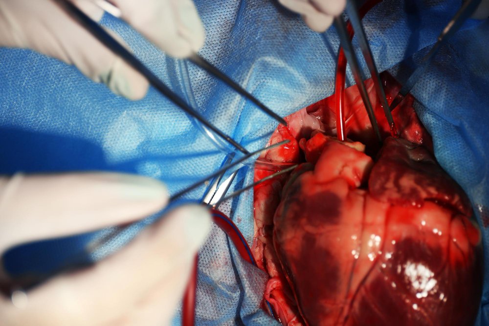 Complex CABG Surgery